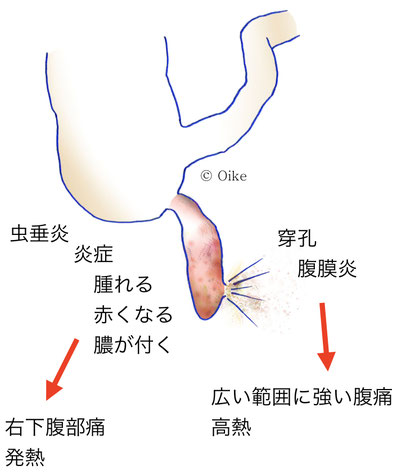 虫垂炎について02