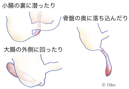 虫垂炎について04