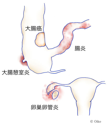 虫垂炎について05