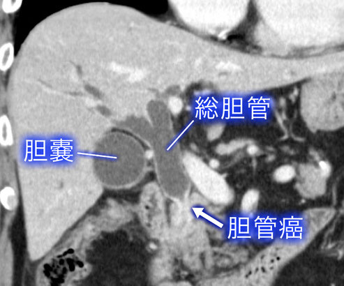 胆管癌について01