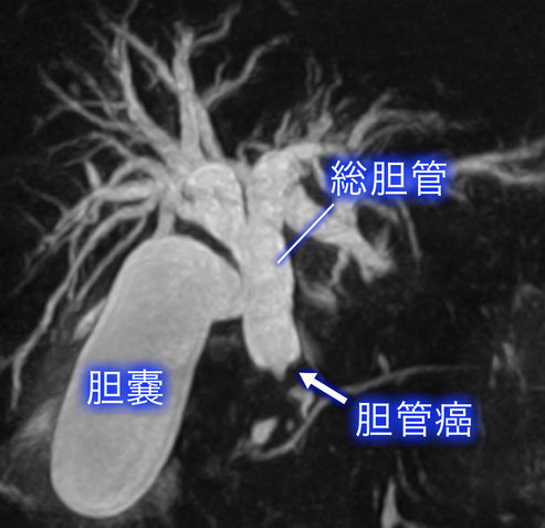 胆管癌について02