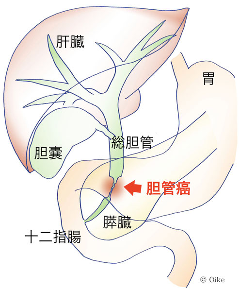 胆管癌について03