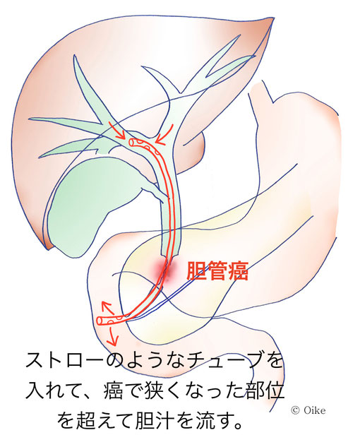 胆管癌について05