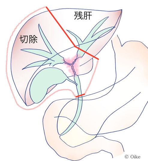 胆管癌について08