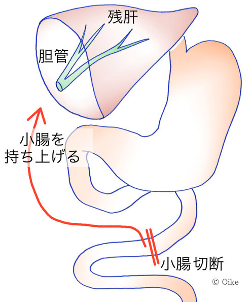 胆管癌について09