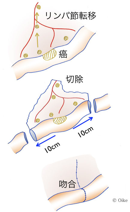 大腸癌について05