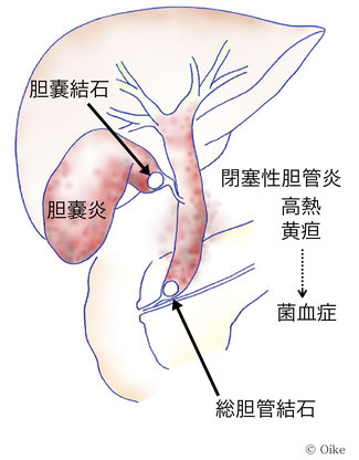 胆石による胆嚢炎