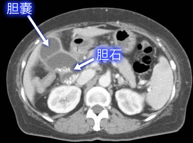 胆石の治療
