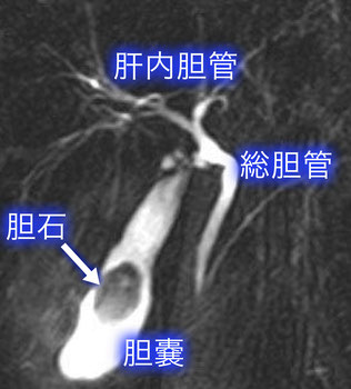 胆石の手術