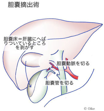 胆嚢摘出術