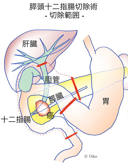 膵癌について01