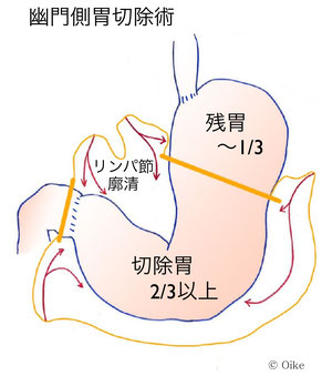 幽門側胃切除術