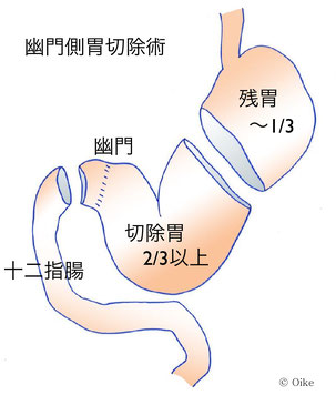 幽門側胃切除術