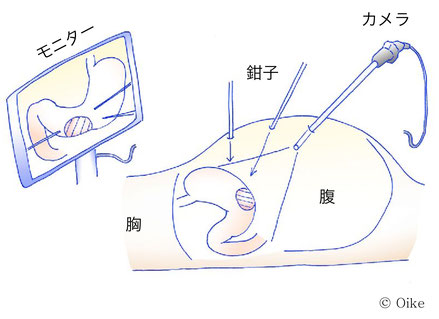 開腹手術